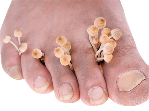 脚气脚臭脚痒便宜又好用的药,脚气脚臭脚痒的克星中草药