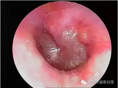 化脓性中耳炎,化脓性中耳炎清理