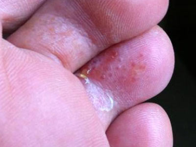 脚气脚臭脚痒便宜又好用的药,脚气脚臭脚痒的克星中草药