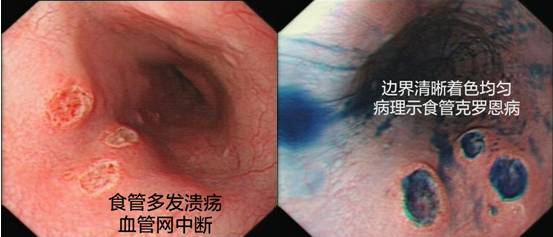 精细胃镜检查（二）——色素内镜（上）