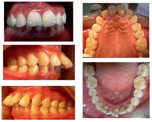 拔牙有风险拔牙需谨慎,拔牙后果严重吗