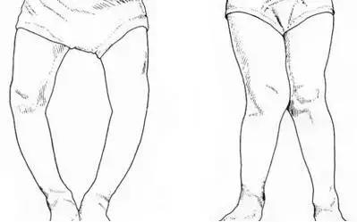 儿童缺钙解决方案,你怎么知道孩子缺钙