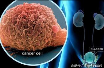 膀胱癌中医辨证分析,膀胱癌中医辨证