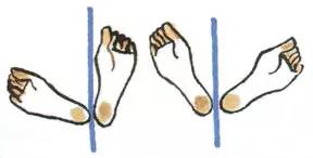 骨盆前倾矫正操,纠正骨盆倾斜的锻炼方法