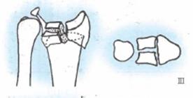 桡骨远端骨折传统石膏打法,成人桡骨远端骨折诊疗指南2023版