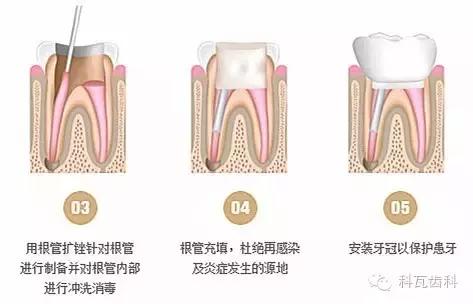 抽神经根管治疗视频,根管治疗全过程抽牙神经