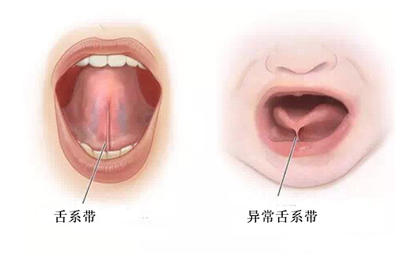 宝宝w型舌需要处理吗,宝宝w型舌头体质怎么样