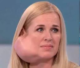 腮腺癌的治疗方案,腮腺癌用啥药治疗