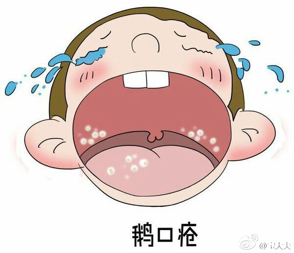 宝宝鹅口疮妈妈有没有要忌口的,宝宝鹅口疮宝妈怎么治