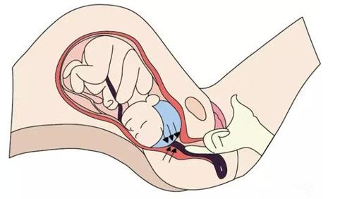 怎样避免脐带脱垂,脐带脱垂防治措施