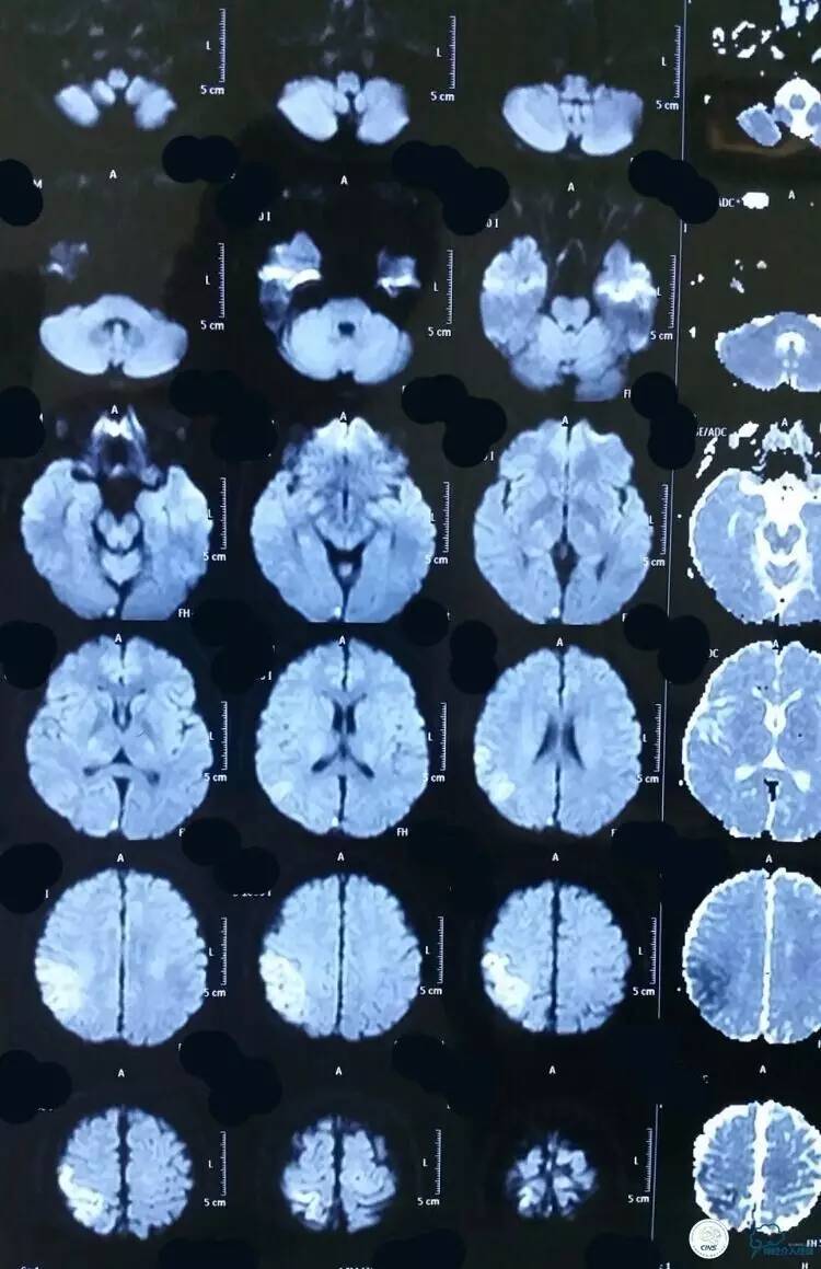 下肢血栓微创介入治疗的费用,急性深静脉血栓形成的诊断和治疗