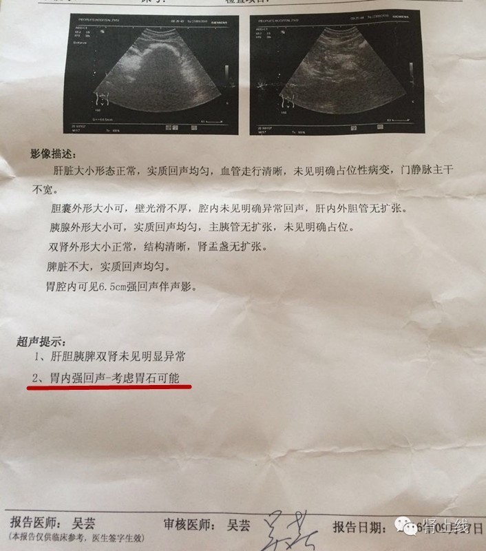 吃山楂取出胃结石,吃10个山楂胃结石有多少