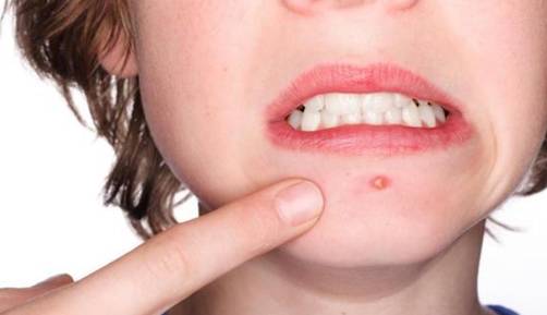 中医外科养生指南之*疮痤**