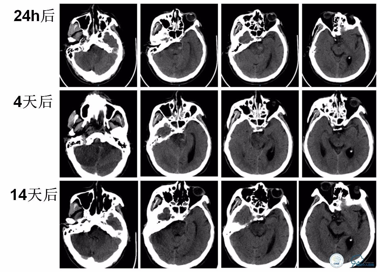 后循环系统梗死,后循环梗死