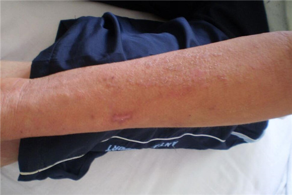 外耳湿疹预防措施,治湿疹四大方法