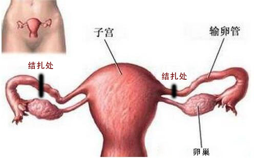 结扎之后可以生二胎吗,结扎过的女人还会怀孕吗