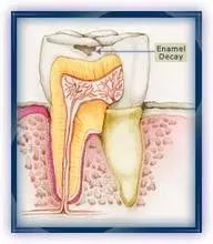 蛀牙怎样才能控制住不再有蛀牙,蛀牙怎么避免更严重
