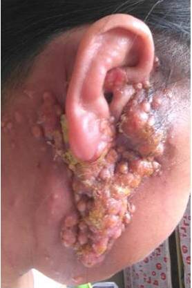 腮腺癌的治疗方案,腮腺癌用啥药治疗