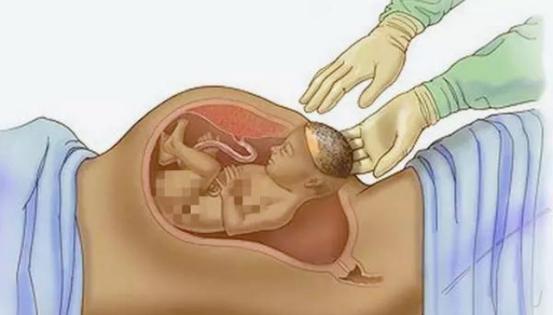 怕疼顺产好还是剖腹产好,剖腹产痛还是顺产痛有经历过的吗