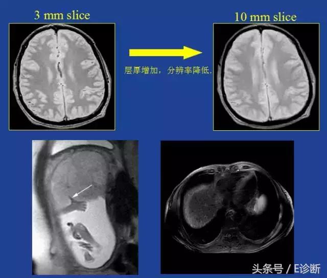 磁共振伪影及解决方案,e系列诊断