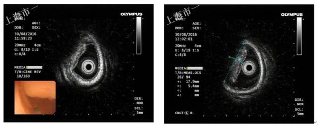 直肠有哪几种情况需要手术,直肠病变esd手术指南