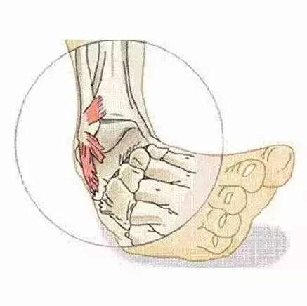 打篮球崴脚了怎么解决呢,打篮球脚崴了应该怎么办