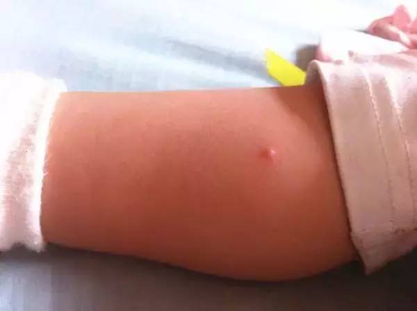 宝宝长水痘妈妈应该怎样预防,四个月宝宝出水痘有什么并发症