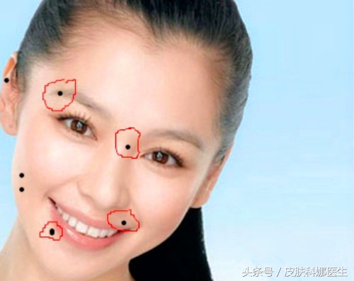 脸上痦子点了会留疤痕吗,脸上哪的痦子不能点