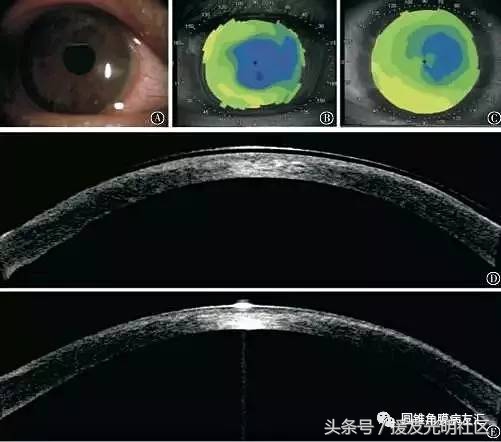 角膜地形图诊断标准,角膜地形图能确诊圆锥角膜