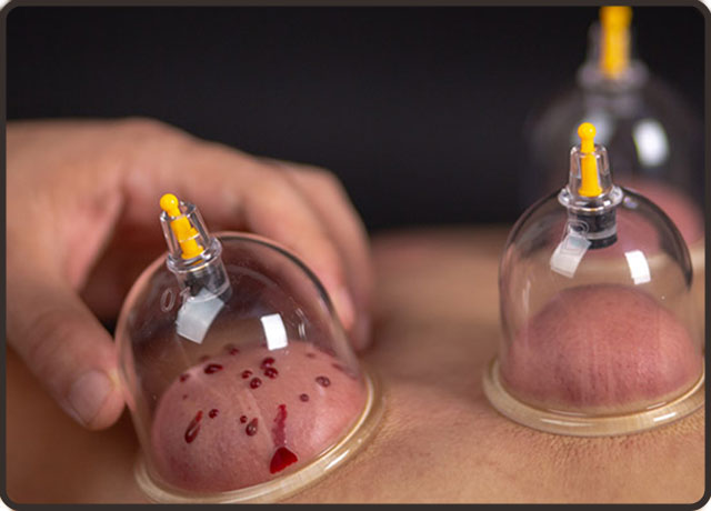 拔火罐注意事项和禁忌,高血压拔火罐注意事项