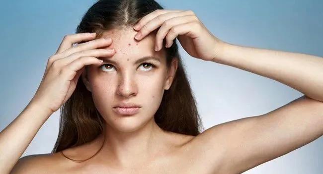 额头后背长痘痘是什么原因,额头长痘痘的原因和解决方法