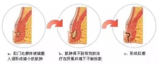 小儿肛瘘五年没复发是自愈了吗,肛瘘每天用高锰酸钾坐浴能自愈吗