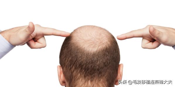 脱发2年,脱发一年了头发明显减少