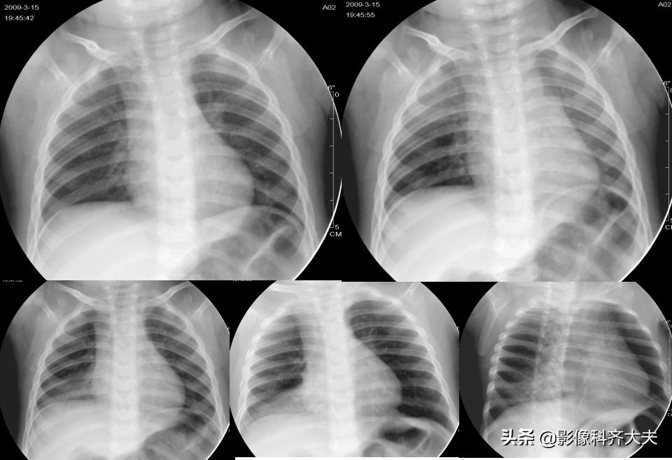 小儿气管镜怎么检查,小儿ct检查全过程视频