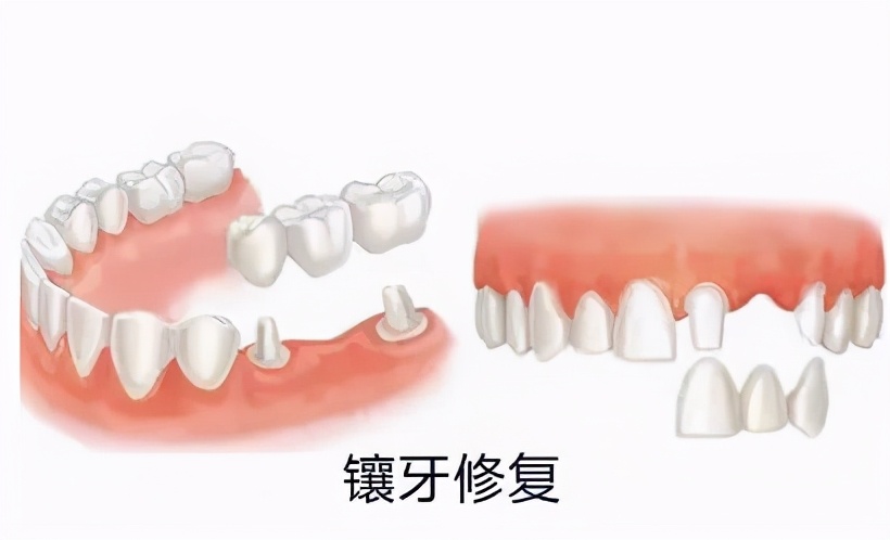 门牙根管治疗后没做牙冠牙齿劈裂,牙齿残冠一定要做根管治疗吗
