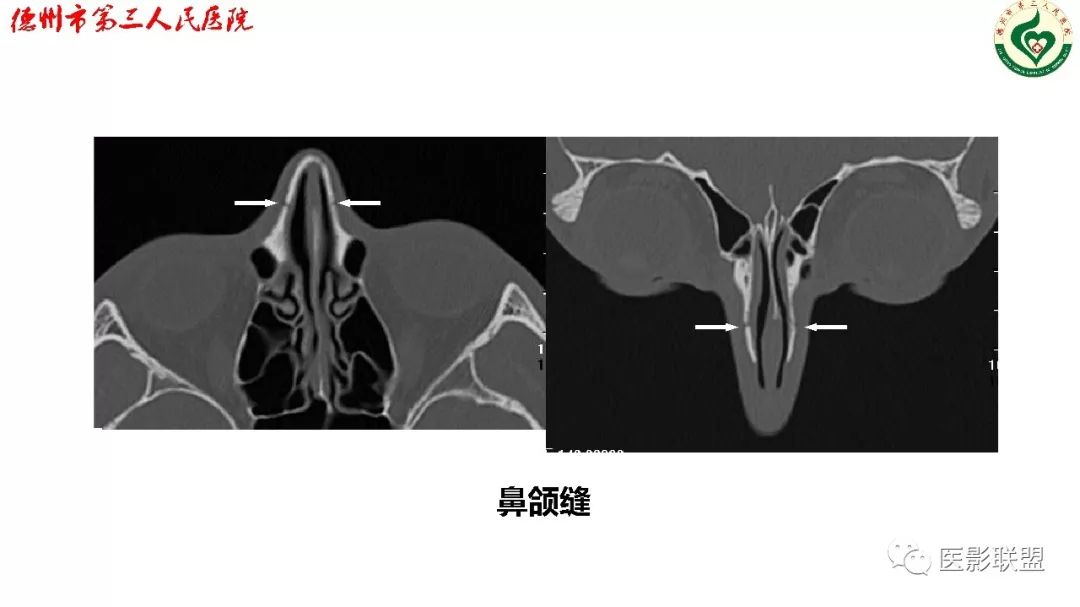 鼻骨骨折影像,鼻骨骨折dr影像表现