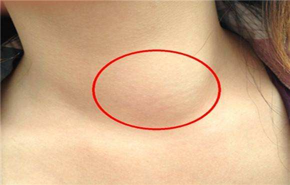 甲状腺结节从生长到发现要多久,甲状腺小结节要治疗吗