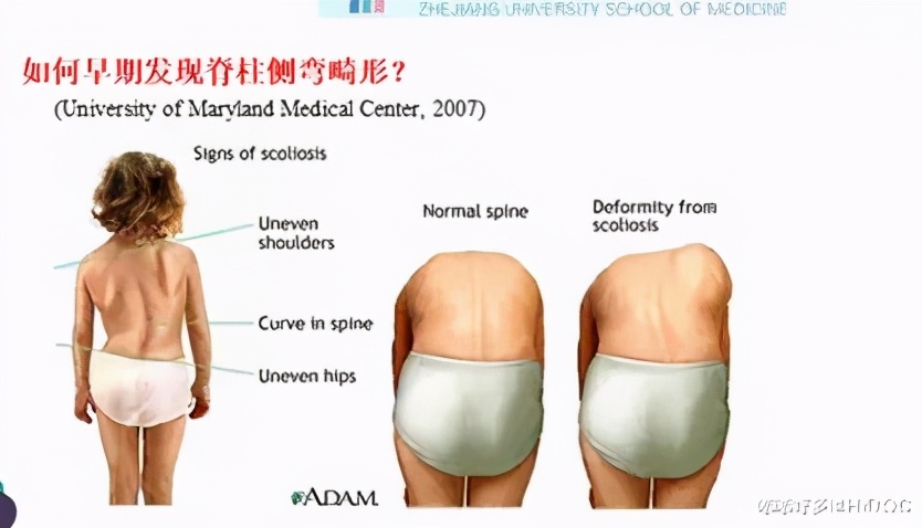 儿童颈椎侧弯会有什么后果,13岁孩子颈椎侧弯矫正睡姿图片