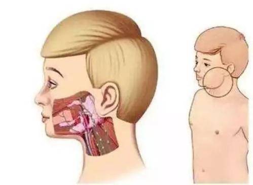 脸部长的腮腺肿瘤,腮腺长了个硬疙瘩一定是肿瘤吗