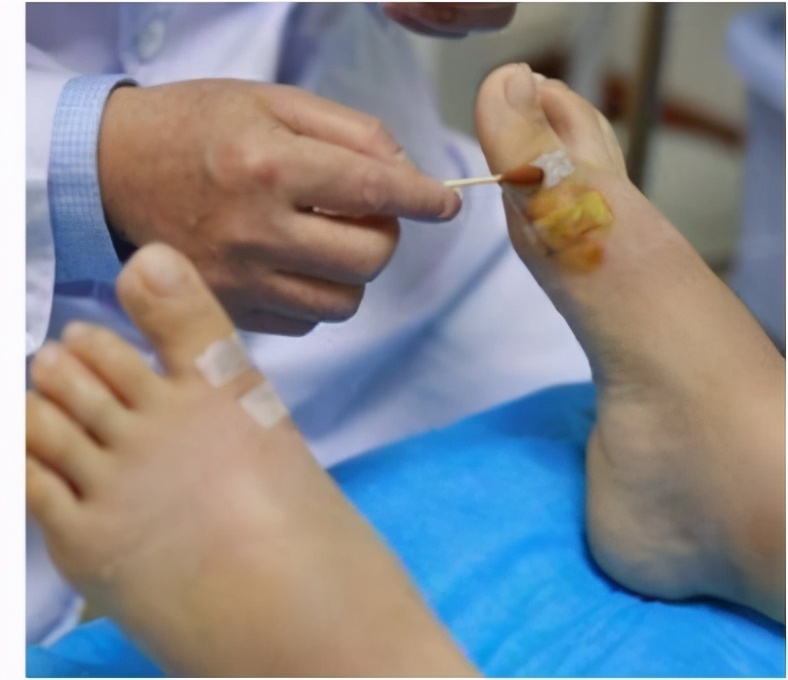 皮肤擦伤有渗出液,皮肤擦伤会留疤吗