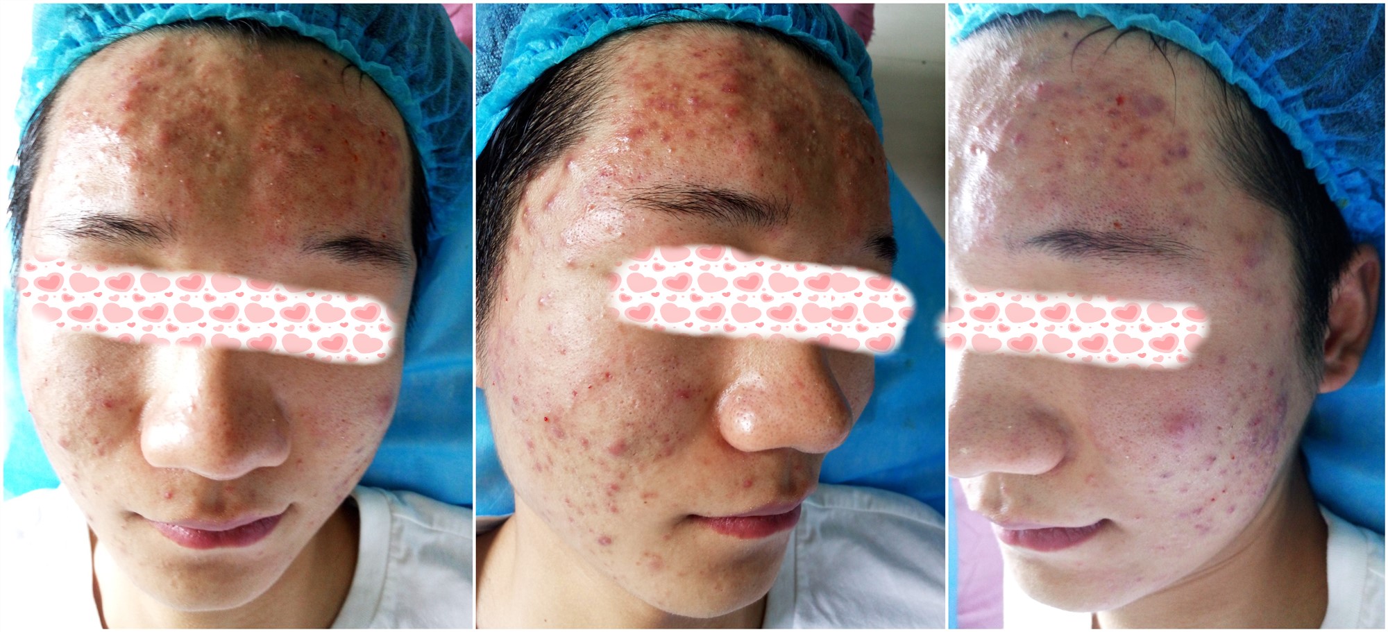 中药痤疮面膜配方大全,治疗痘坑的中药配方面膜