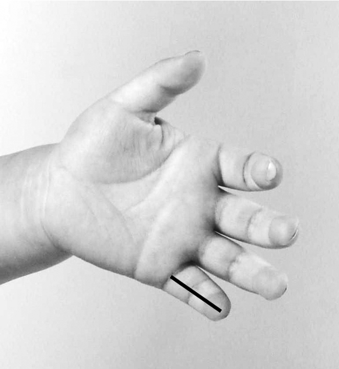 儿童感冒反复发烧怎么降烧,小孩反复发烧物理降温的正确方法