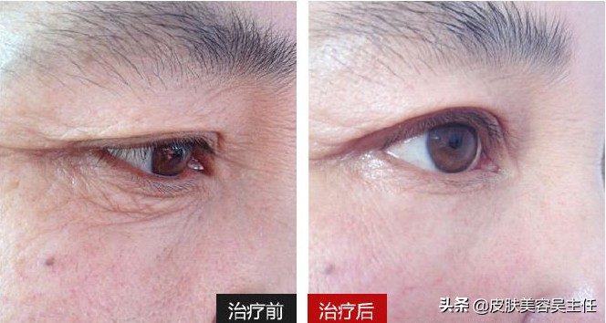 做热玛吉打过麻药能泡温泉么,做热玛吉还需要打水光针吗