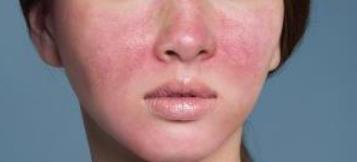 敏感干燥起皮泛红怎么修复,泛红起皮有刺痛感如何护肤