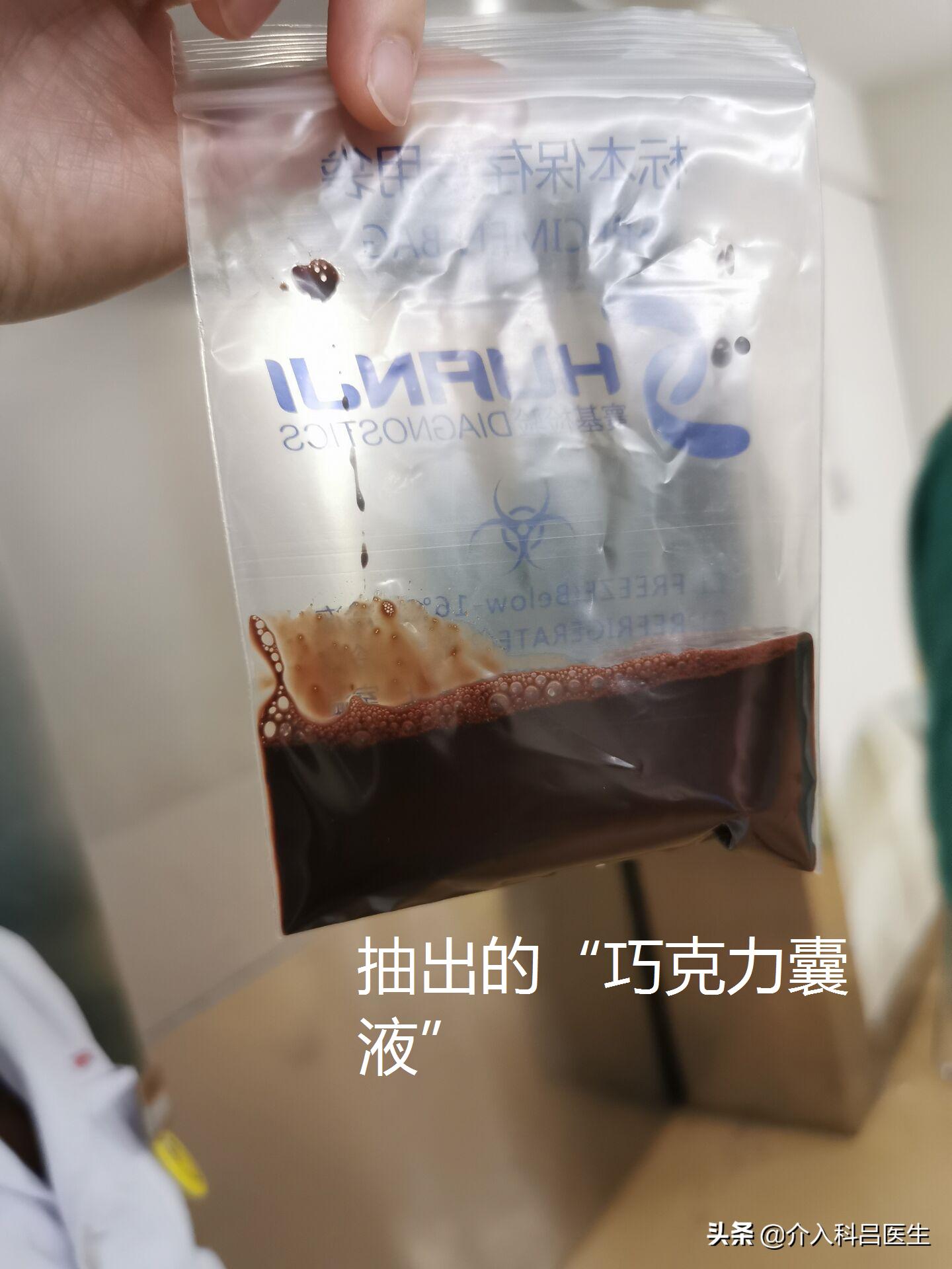 河南卵巢囊肿介入治疗哪家好,一根针治疗卵巢囊肿过程