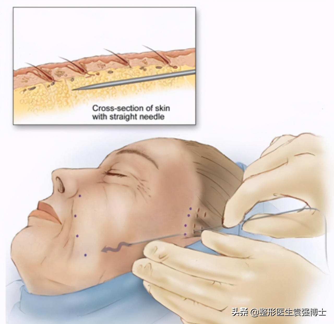 不同年纪应该做哪些医美项目,不同年龄应该选择什么医美项目