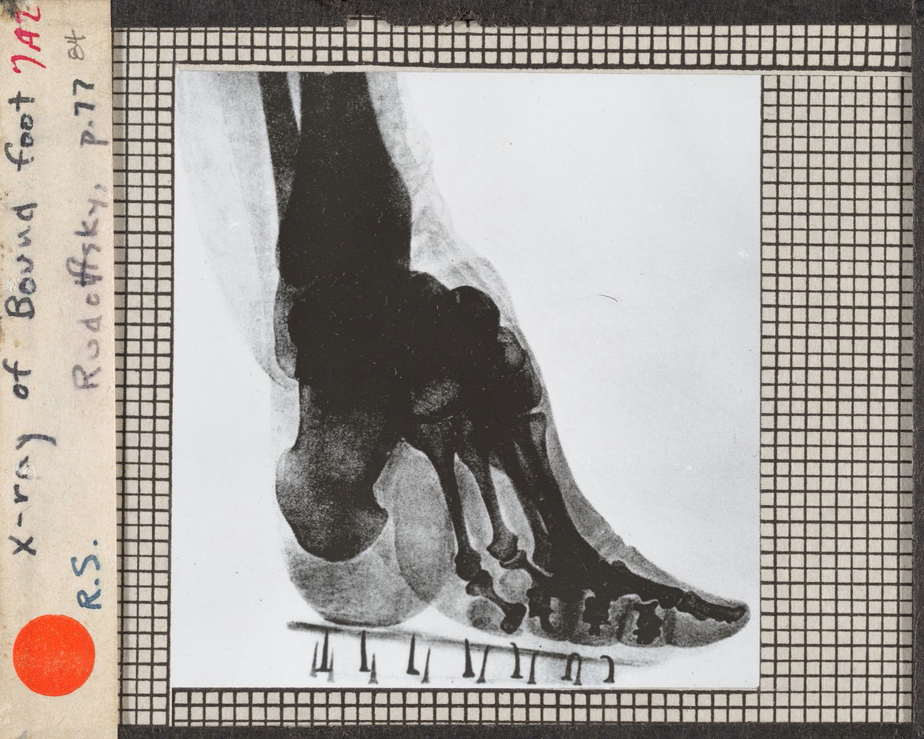 实拍三寸金莲裹脚缠足全过程,三寸金莲的缠足过程