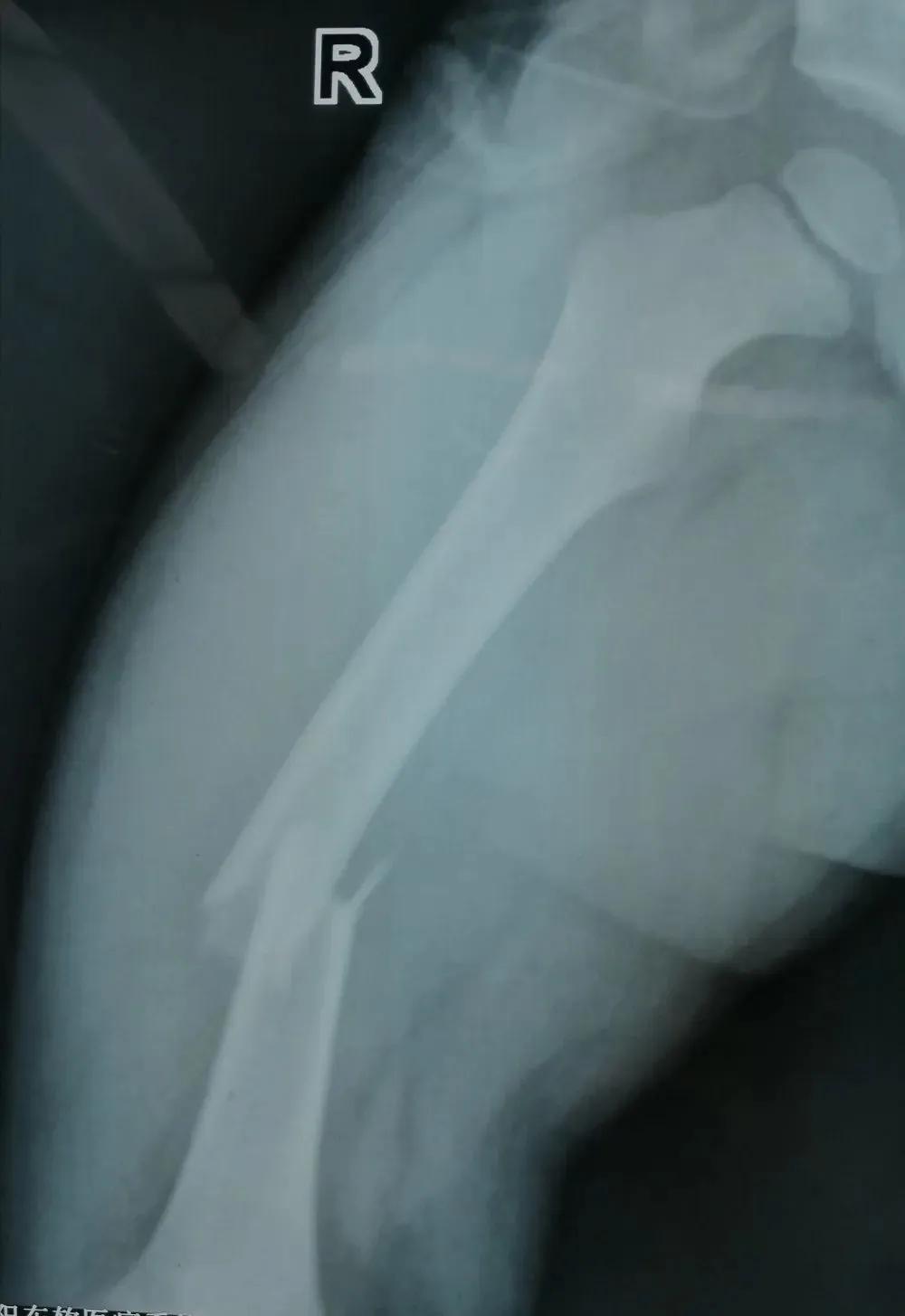 景谷县人民医院外二科微创治疗小儿骨折，让骨折的孩子少受苦