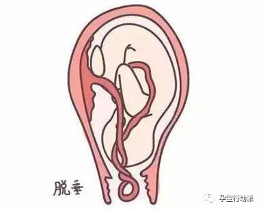 脐带脱垂胎儿存活几率有多大,为什么会发生脐带脱垂