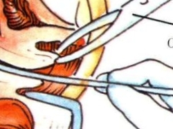 人工流产饮食方面如何注意,45天人工流产后注意什么